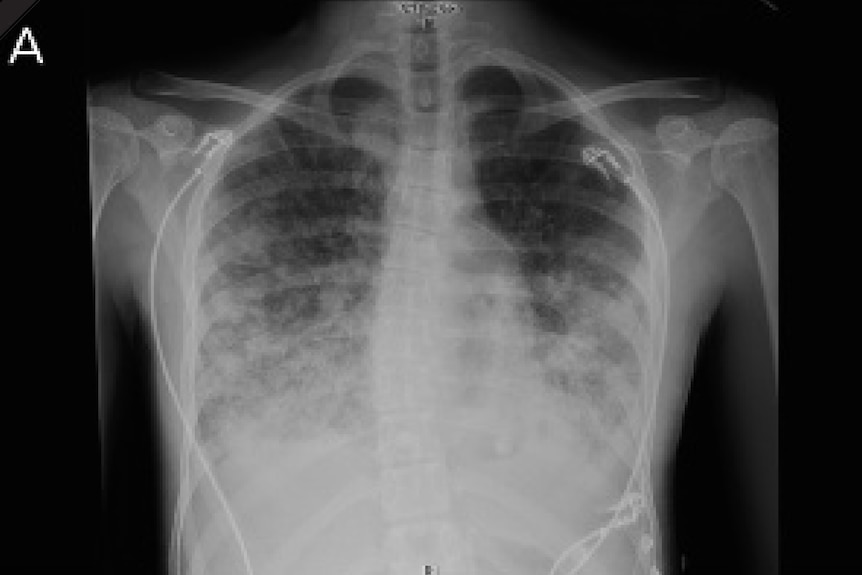 An X-ray of Dakota Stephenson's lungs, showing fluid where it shouldn't be.