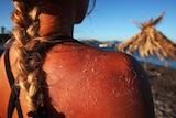 A woman's sunburnt shoulder with peeling skin.