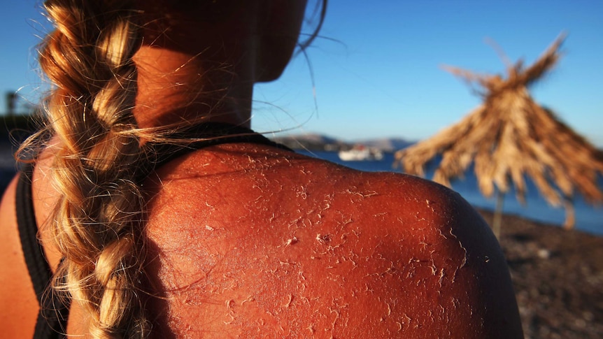 A woman's sunburnt shoulder with peeling skin.