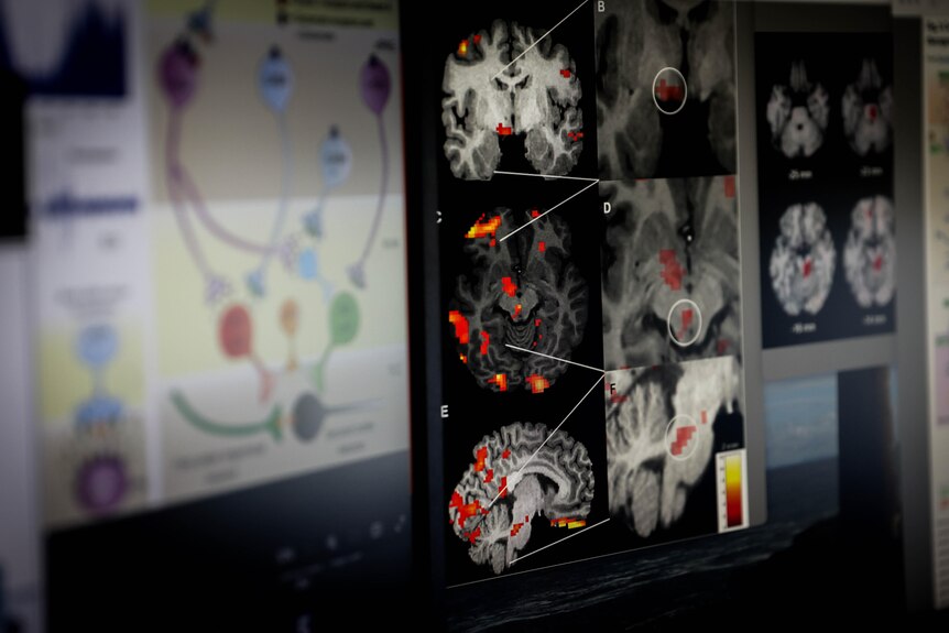 Multiple MRI images of a brain with areas marked in red and yellow. 