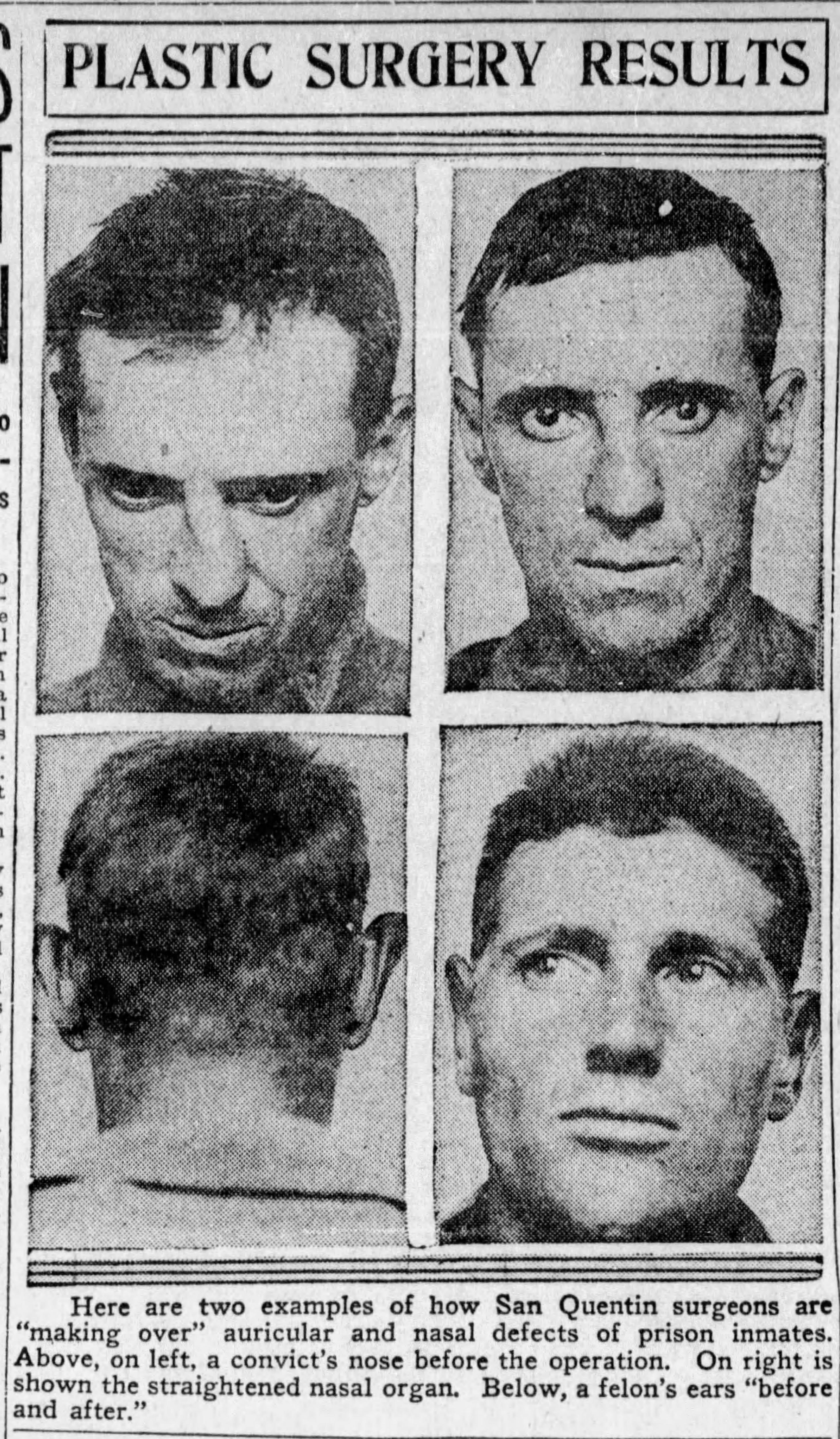 Black and white 'before' and 'after' images of two men, the first with crooked and then straightened nose.