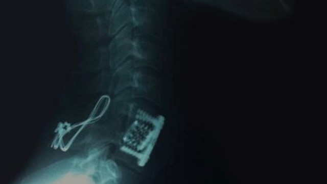 X-Ray of Phillip Harris showing titanium metal inserted into his spine