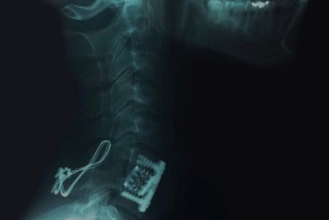 X-Ray of Phillip Harris showing titanium metal inserted into his spine