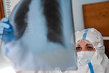 A doctor checking an x-ray of a COVID-19 patient's lungs