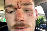 A young man with a moustache sits in a car and takes a selfie. His face is cut and bruised.