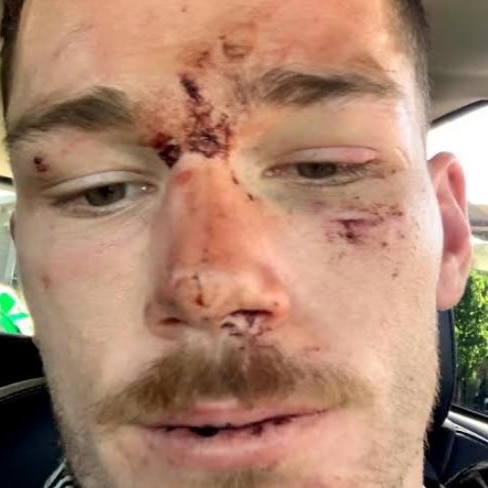 Tom Starling looks into the camera with bruising to his face and blood.