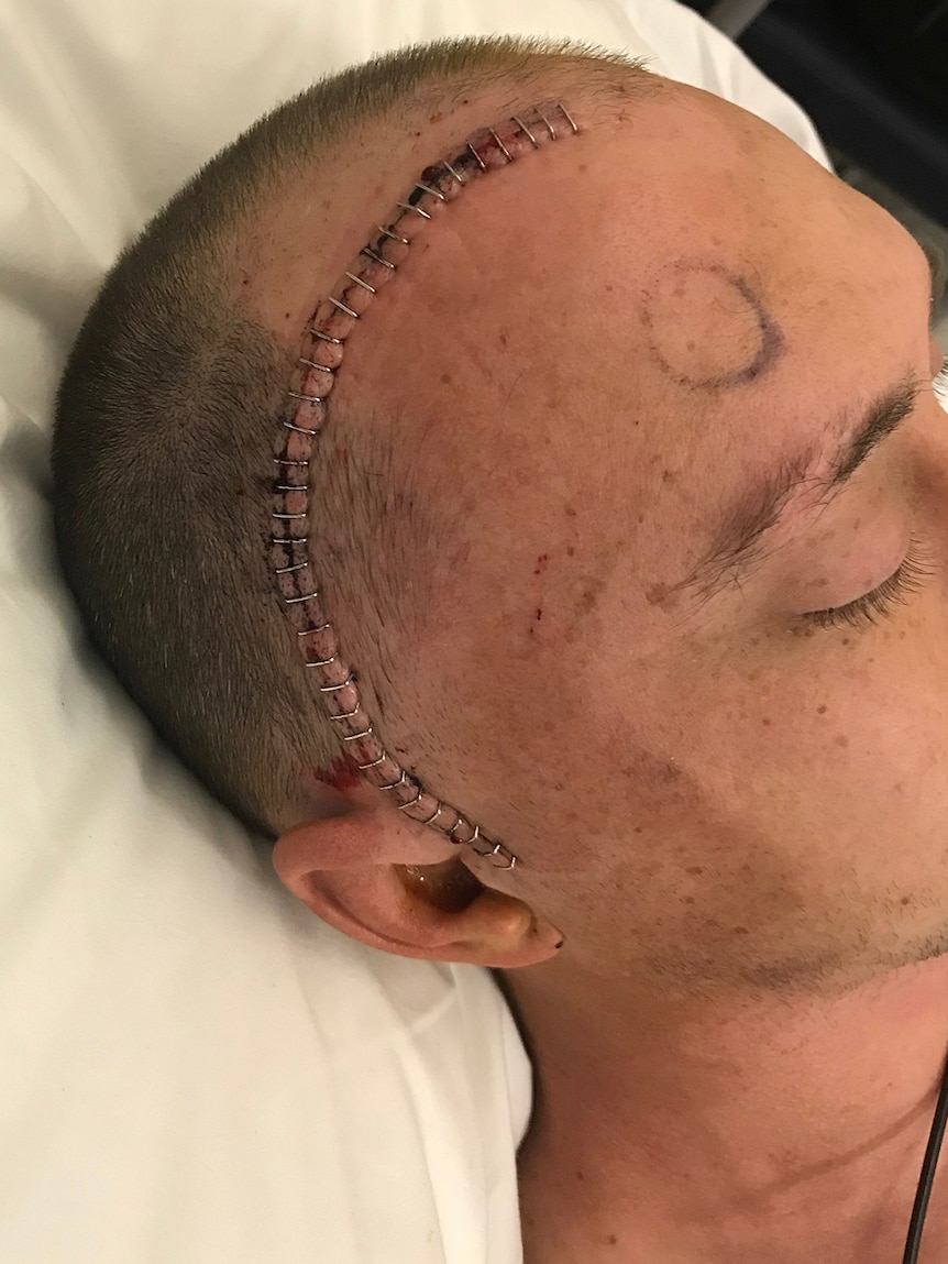 Man in hospital after brain surgery with large scar on his head.