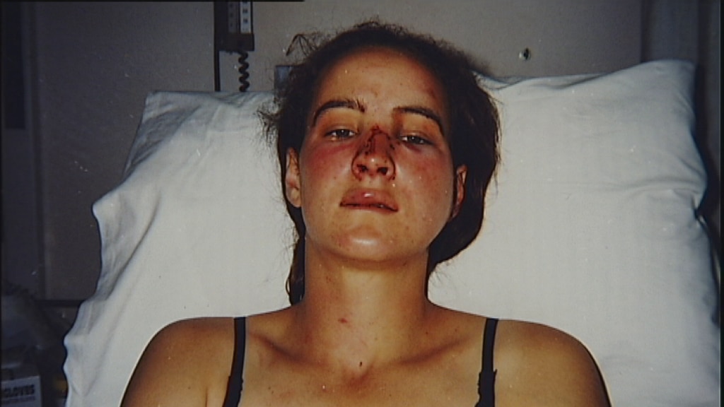 Corinna Horvath in hospital after she was bashed by Victorian police officers in 1996.