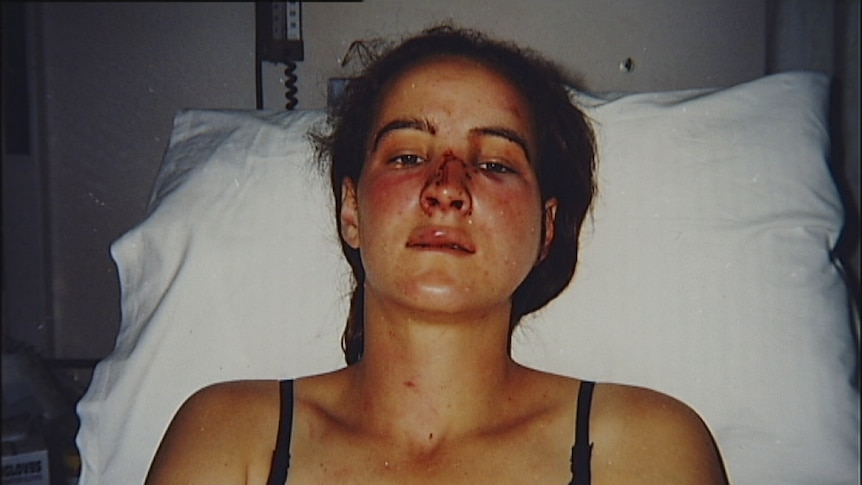 Corinna Horvath lies in a hospital bed with visible facial injuries.