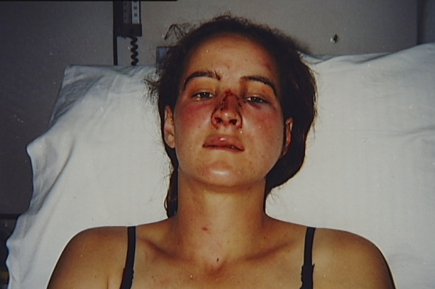 Corinna Horvath lies in a hospital bed with visible facial injuries.