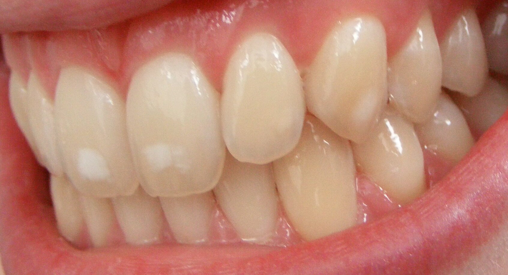 Closeup of teeth in mouth, front teeth have paler white patches on them.