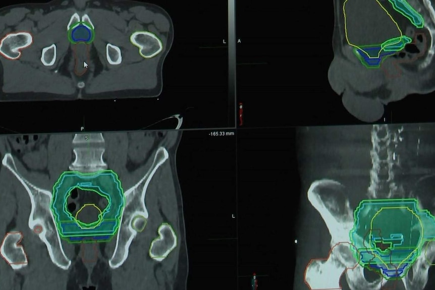 Scans of a man's pelvis and lower spine.