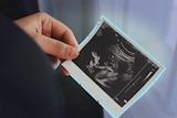 Unidentified woman in foreground holding black and white holding ultrasound of baby scan with blue line around the scan