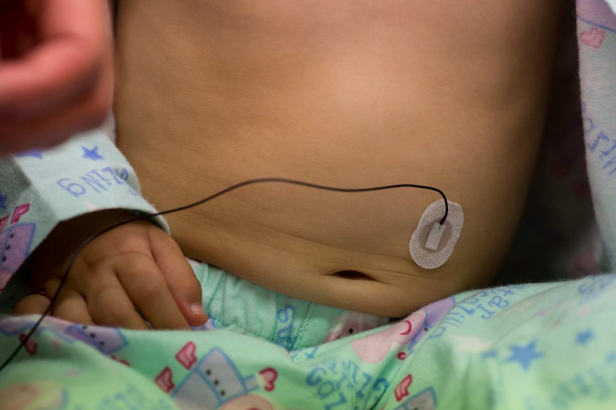 Pads placed on Melina's stomach to her movements and arrivals during sleep study.