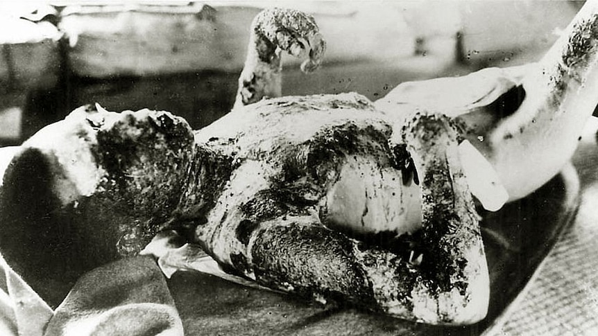 Black and white photo of a badly burnt man lying on a blanket