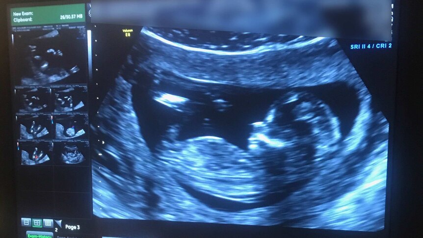 An ultrasound showing Kirsty Brown's baby in utero