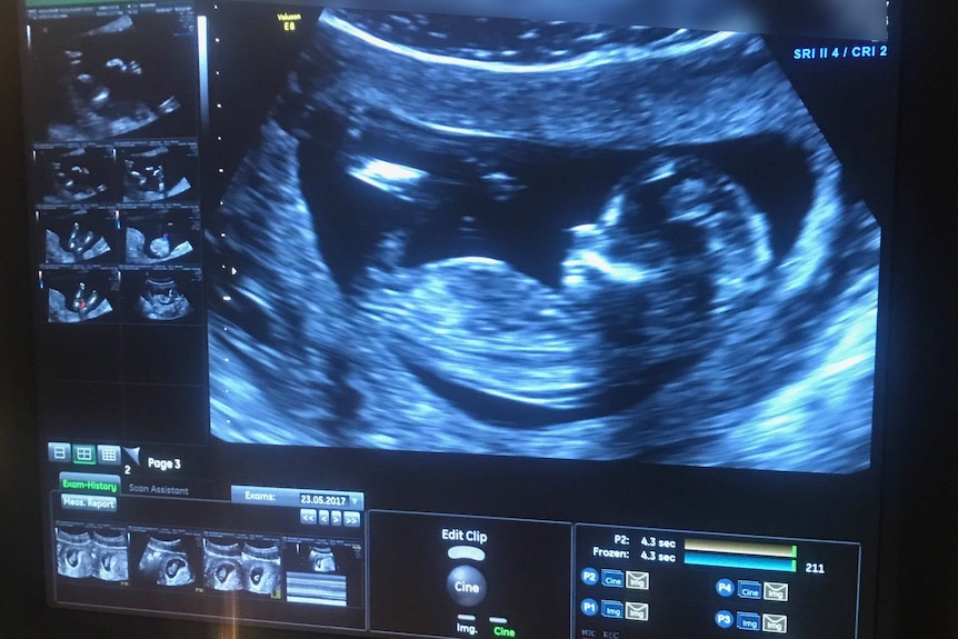 An ultrasound showing Kirsty Brown's baby in utero