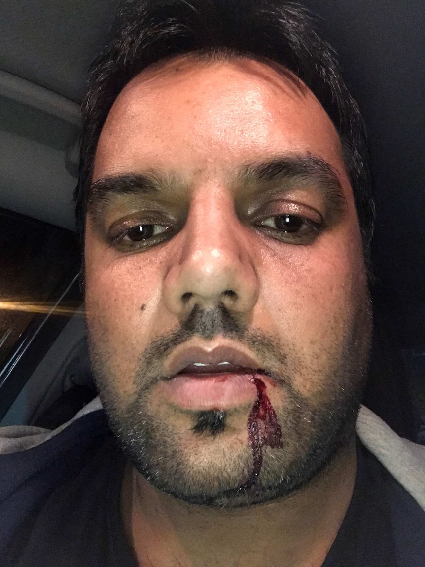 The blood-stained face of Raul, a rideshare driver who was punched in the face by a passenger.