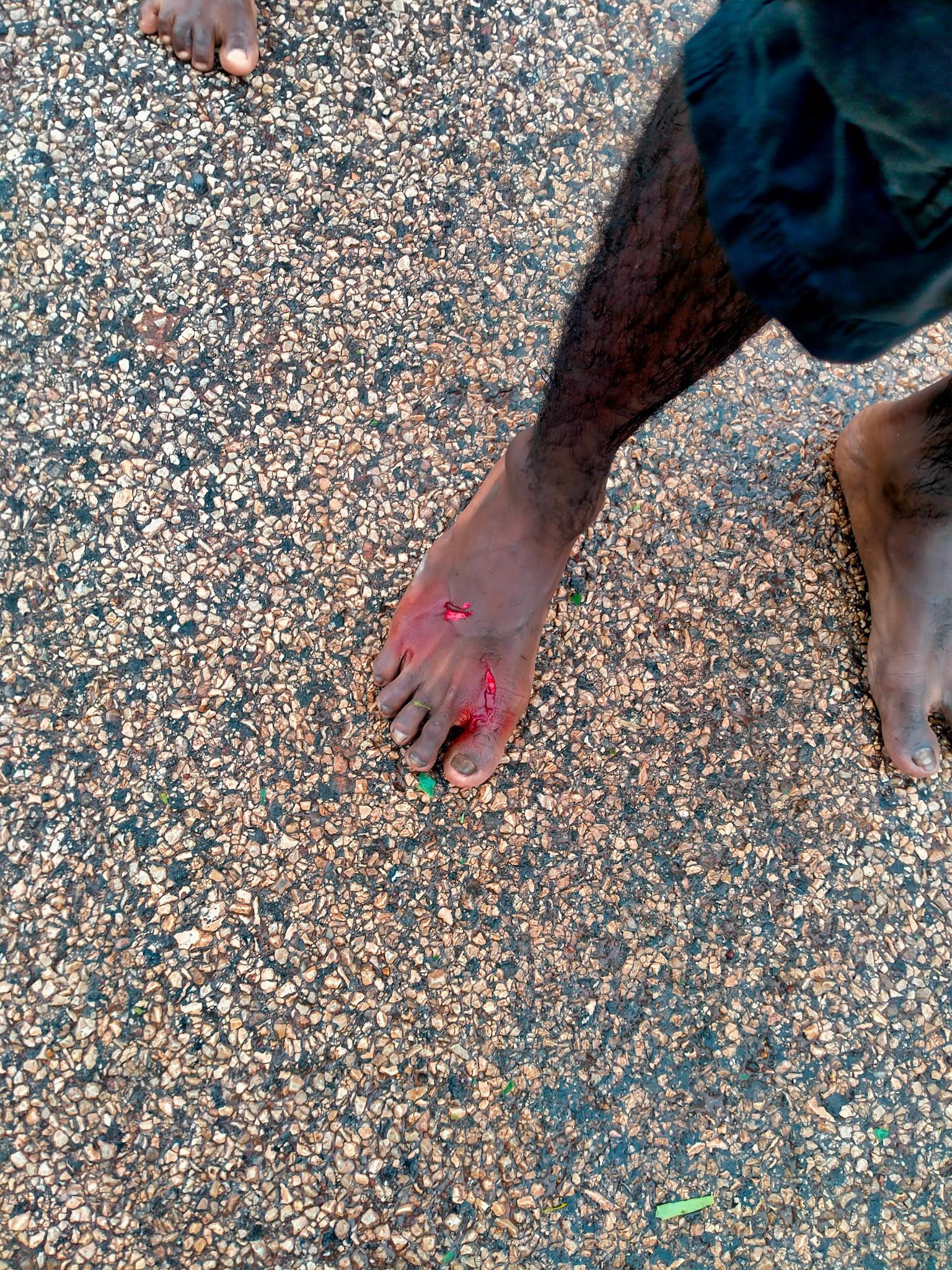 A man's foot with large bleeding bite marks