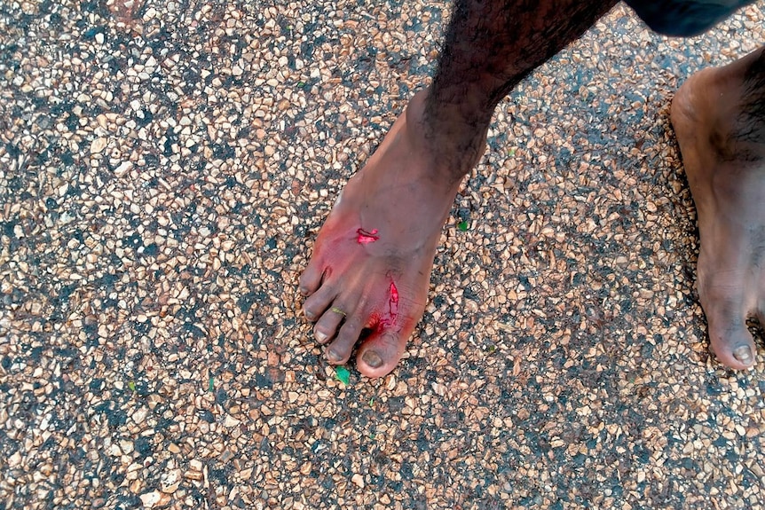 A man's foot with large bleeding bite marks
