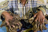 Abul Bajandar sits in a hospital ward showing his massive hands that look like they are covered in bark.
