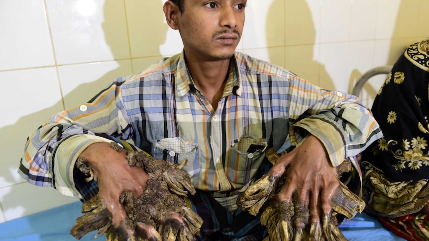Abul Bajandar sits in a hospital ward showing his massive hands that look like they are covered in bark.