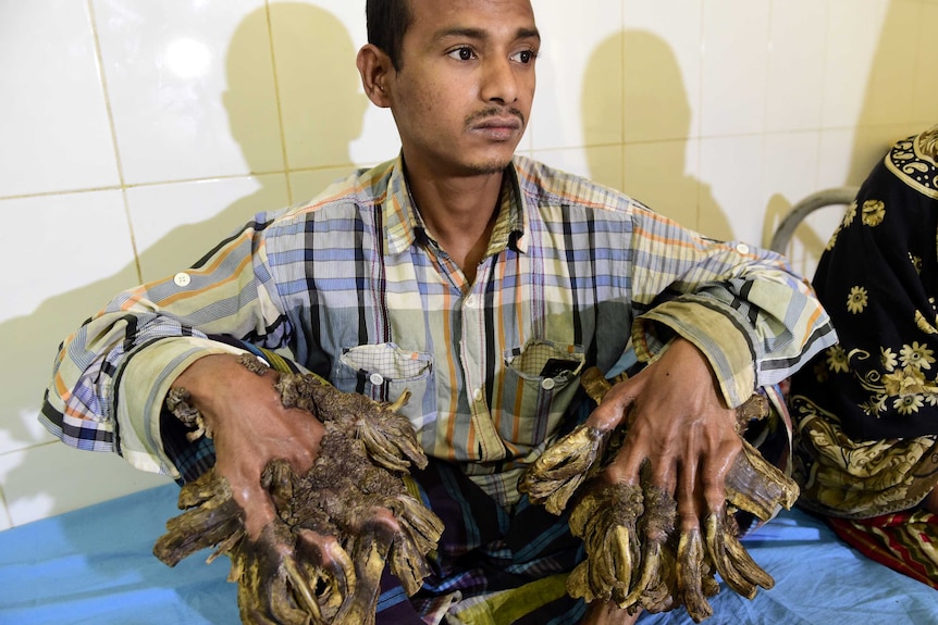 Abul Bajandar sits in a hospital ward showing his massive hands that look like they are covered in bark.