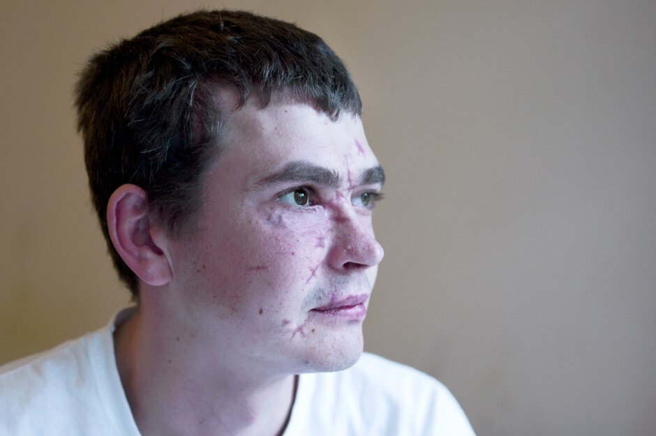 Andriy (28), a conscript from Kiev, waits for plastic surgery to remove the shrapnel still in his face.