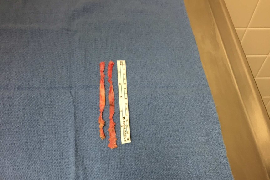 A mesh sling after it has been removed