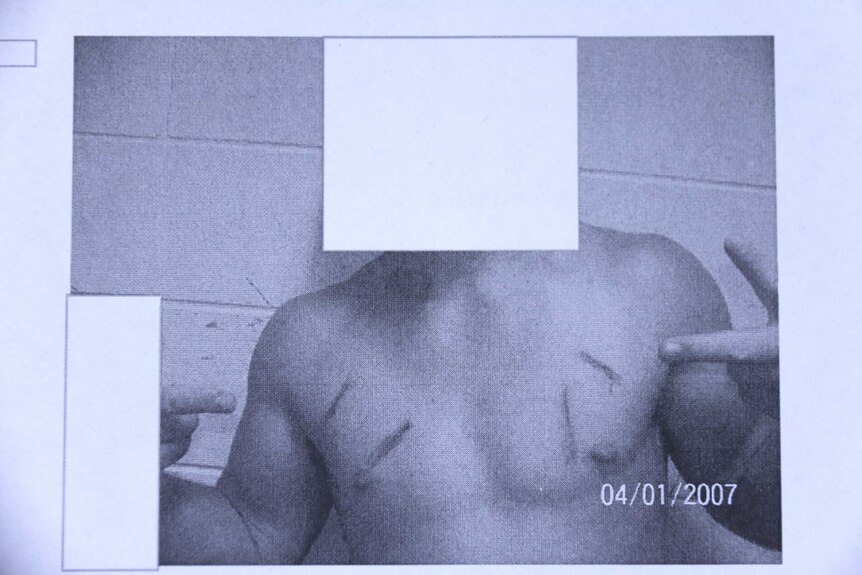 Chest wounds on a youth at Cleveland Youth Detention Centre