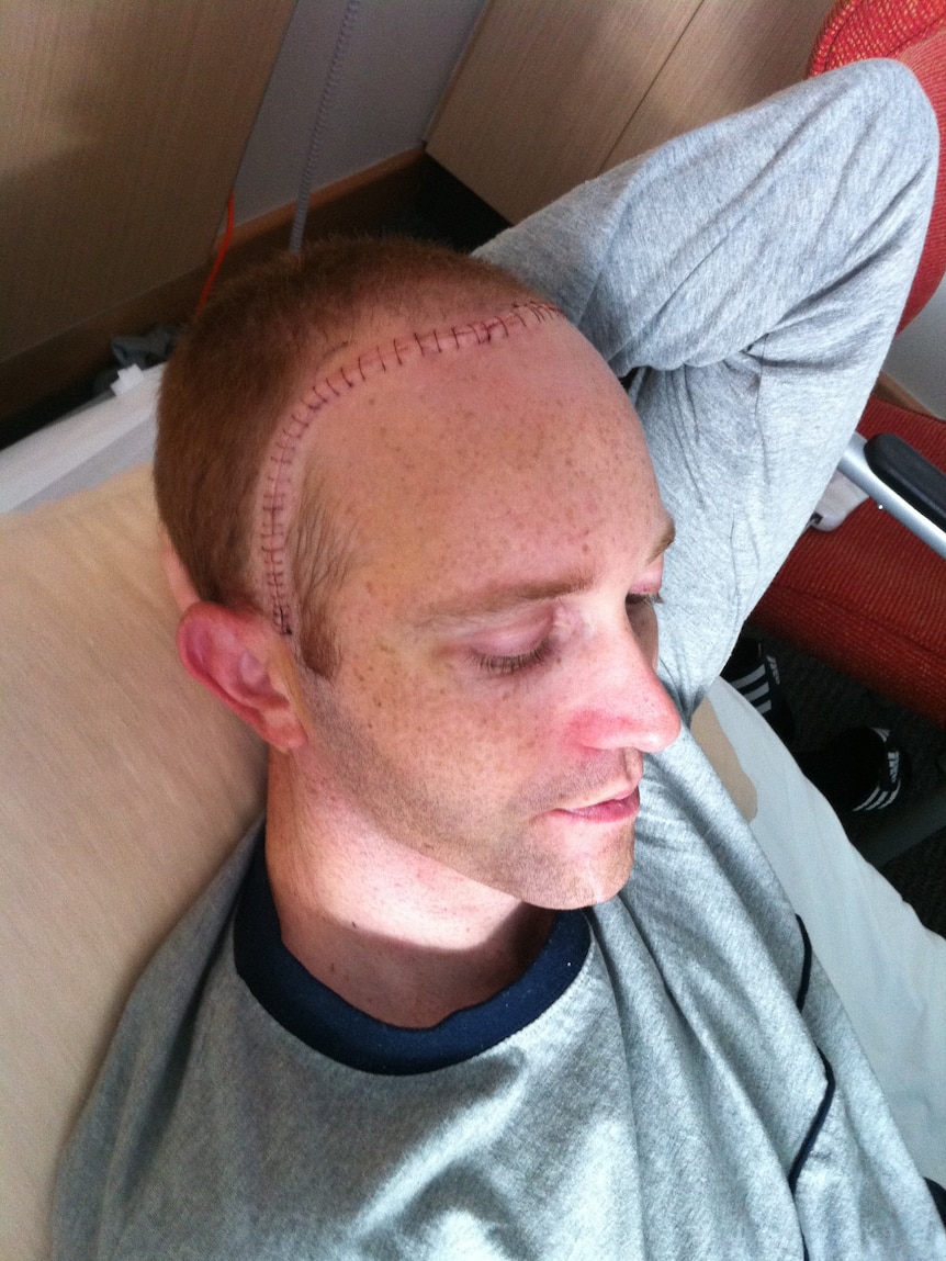 A young white man with a large surgical scar running across his head. He is lying down with his eyes closed