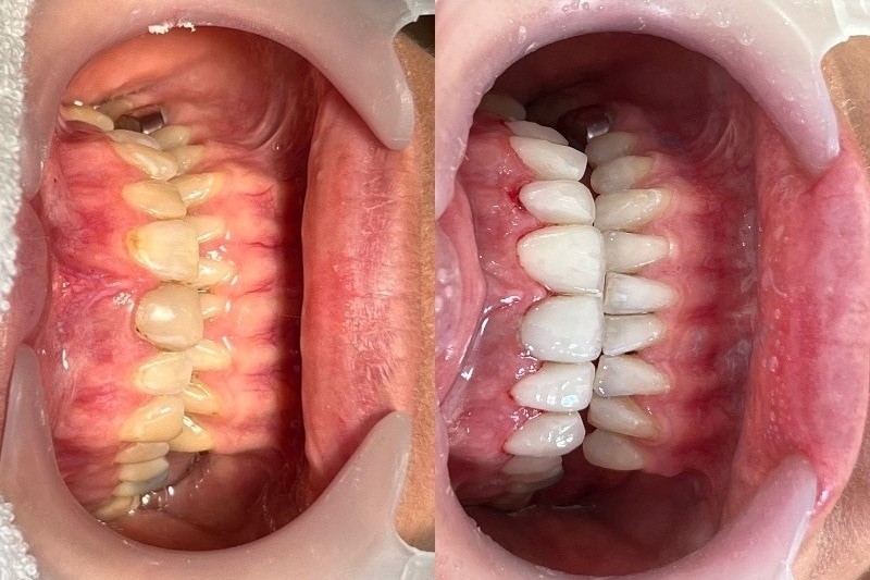 A composite image of two sets of teeth. The first, yellow and damaged. The second, white and clean.