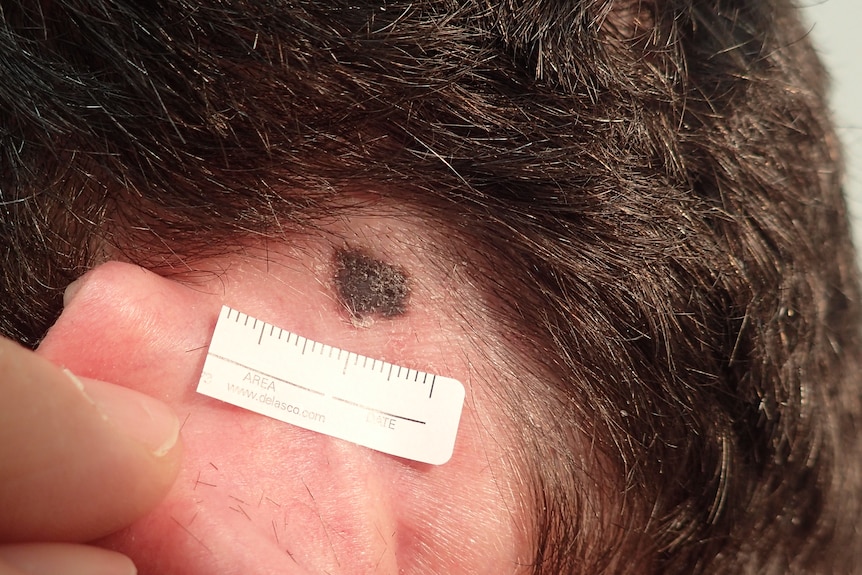 A close up of a dark patch behind a man's ear. For a story on telling children about a cancer diagnosis. 