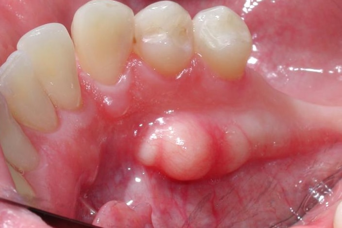 A close-up image of a bony growth near the bottom teeth