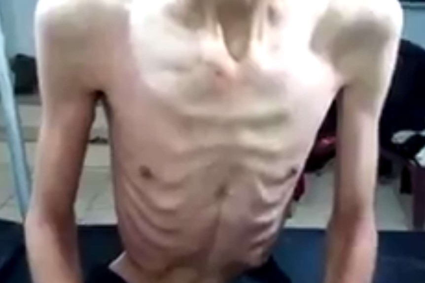 Starving man in Madaya, Syria