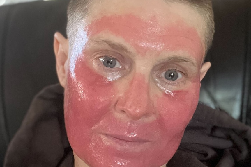 A lady with a red face following chemo treatment.