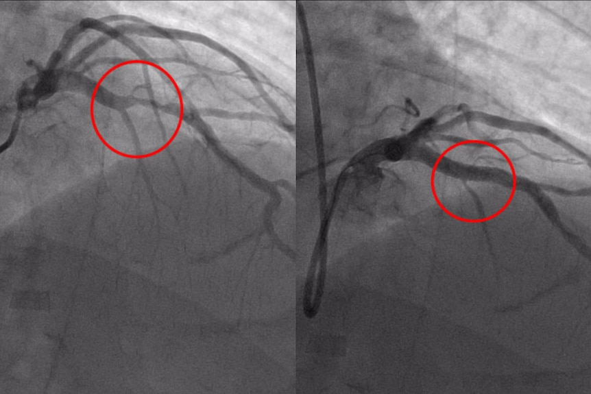 Angiogram images showing Greg Mullin's heart artery blocked and unblocked.