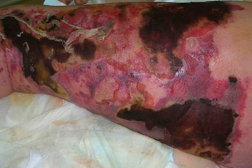 Wounds on the leg of a 43-year-old man infected with necrotising fasciitis.