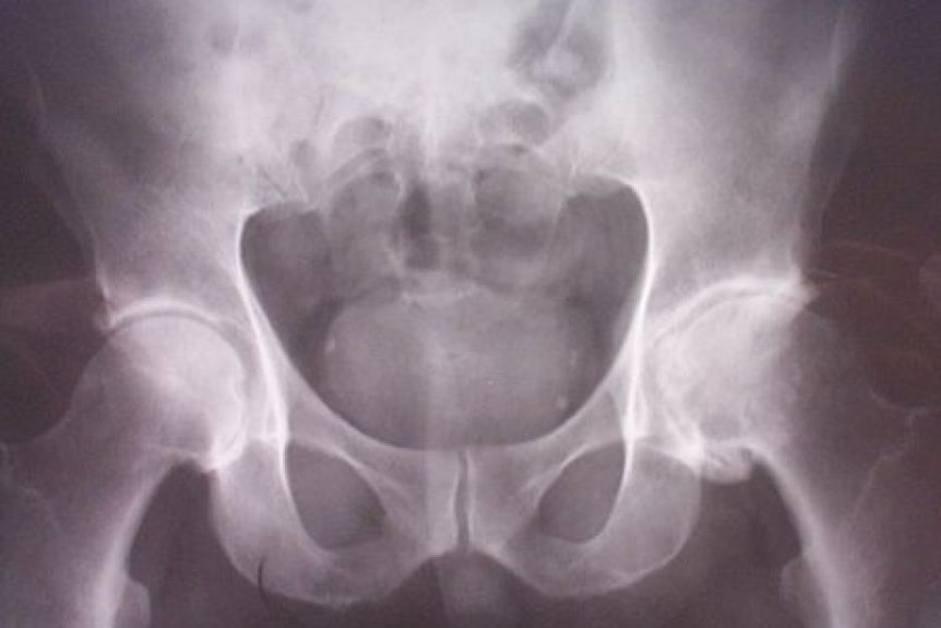 Hip xray.