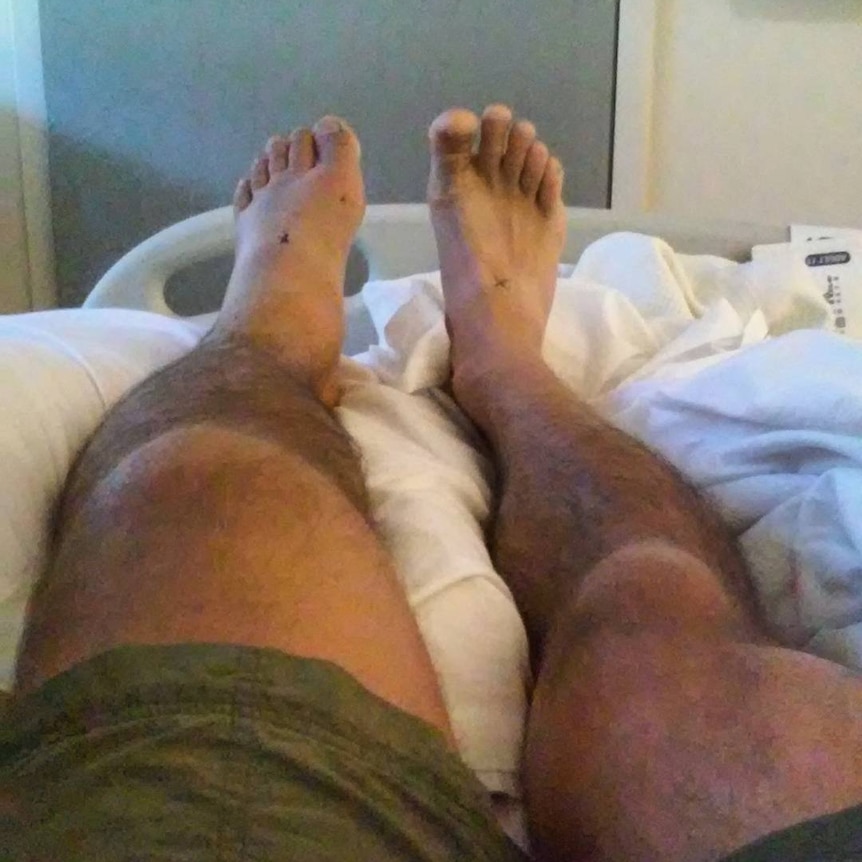 A man's swollen left leg is shown next to his right leg for comparison as he recovers in hospital.