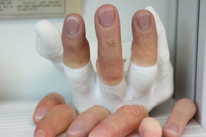 Prosthetic fingers