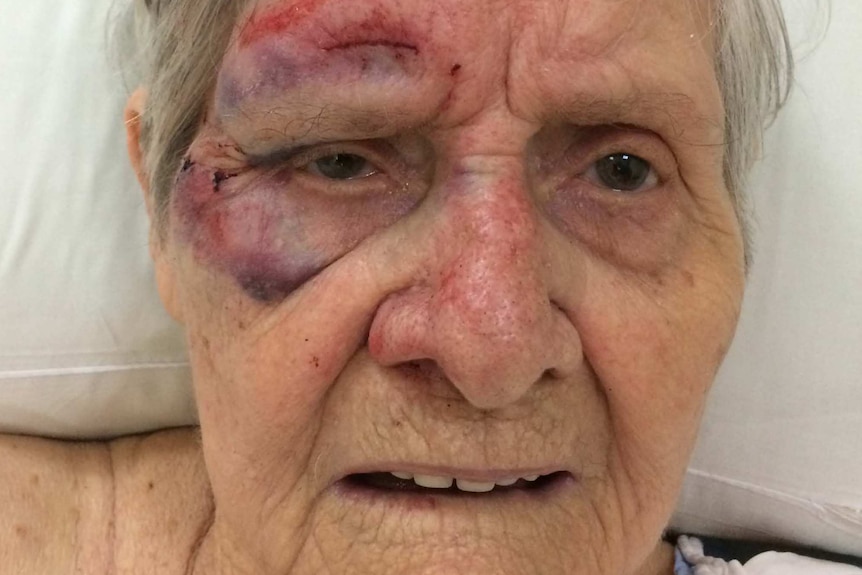 An elderly lady with bruises on her face.
