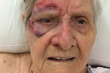 An elderly lady with bruises on her face.