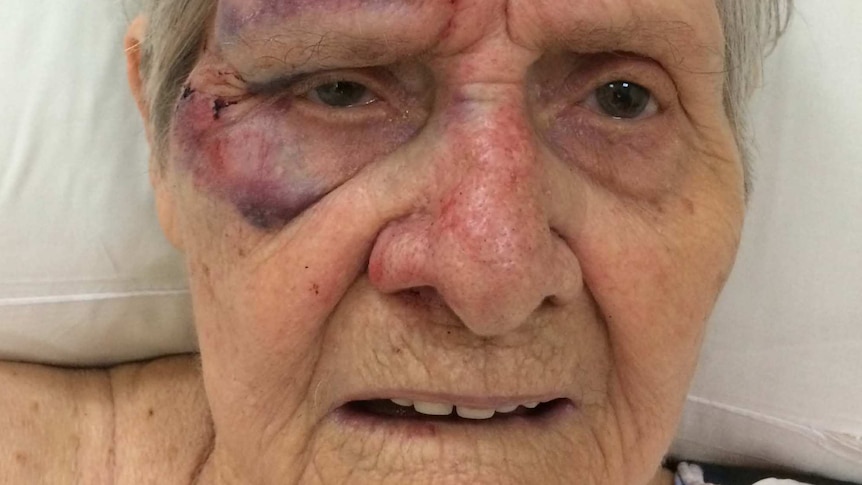 An elderly lady with bruises on her face.