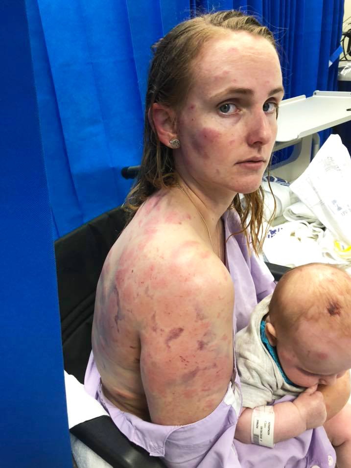 Mother Fiona Simpson, with her baby, was badly injured after being pelted by hail.