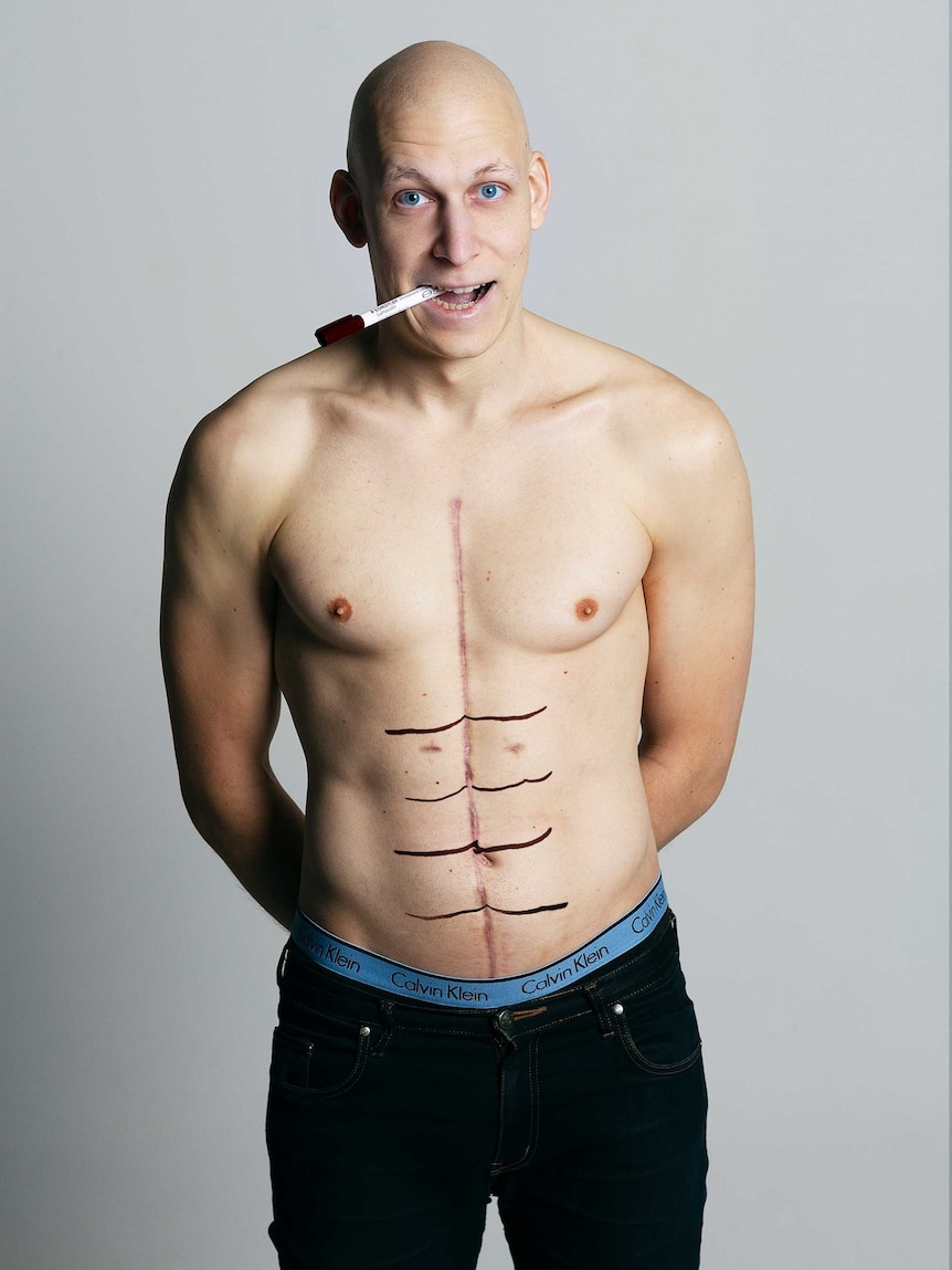 A bald man with a texta in his mouth and a long scar down his abdomen and black texta markings as abdominal muscles.