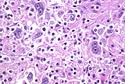 lymphoma