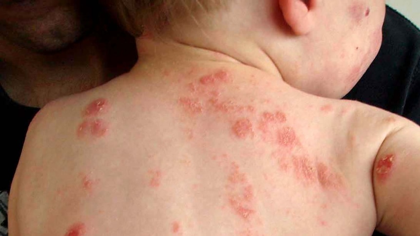 A baby with eczema on its back