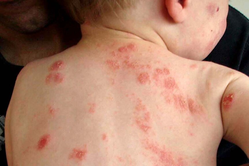 A baby with a red rash on its back