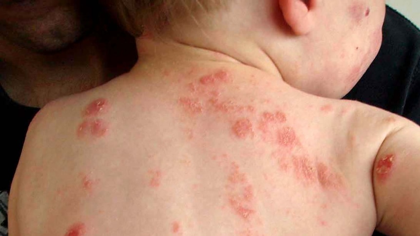 Baby with rash